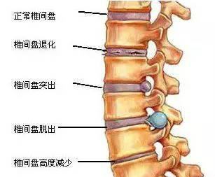 腰间盘突出