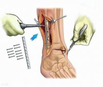 骨折后打的钢板、钢钉，一定要取出来吗？